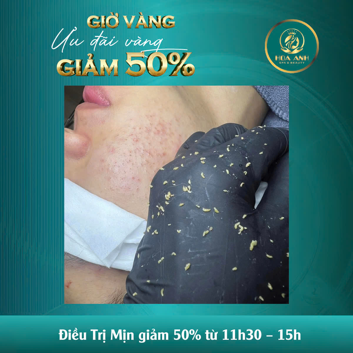 Mụn Tái Đi Tái Lại Ở Tuổi Dậy Thì: Hiểu Đúng – Trị Đúng Cùng Chuyên Gia Thẩm Mỹ Viện Hoa Anh