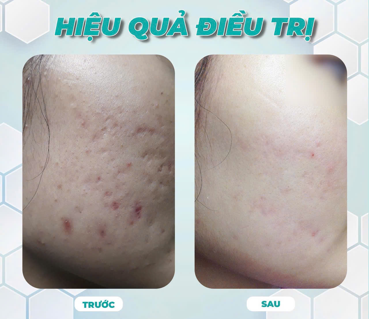 Sẹo đáy nhọn sau mụn có hết không? Nỗi lo thầm kín và lời chia sẻ từ Thẩm mỹ viện Hoa Anh