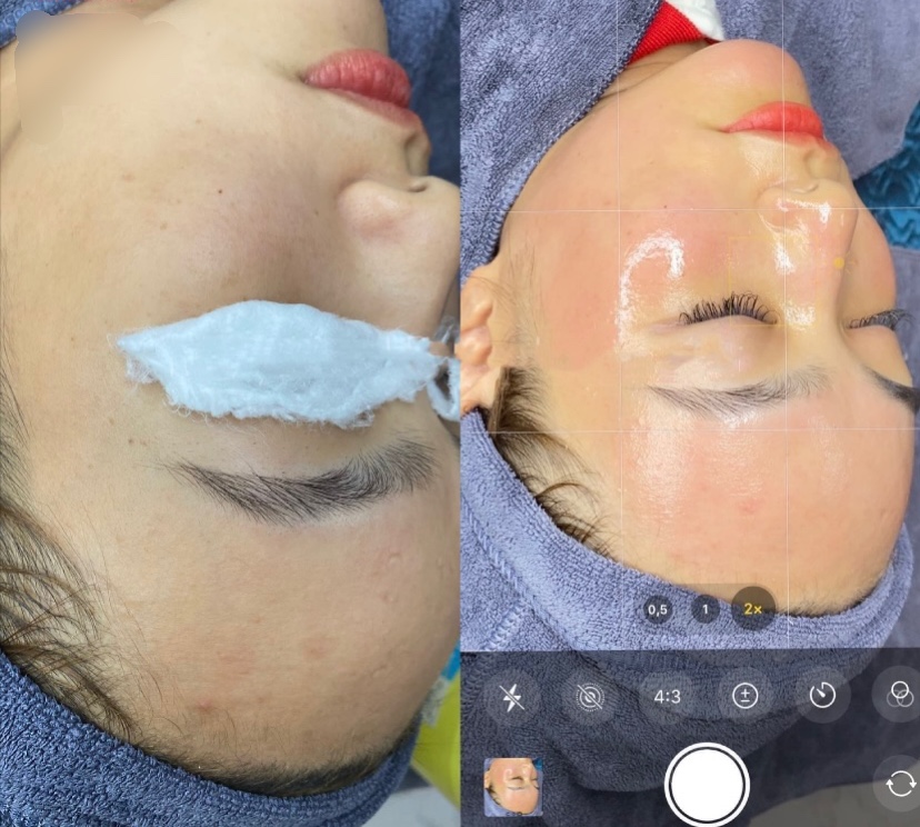 Hướng dẫn cách chăm sóc da sau tiêm meso