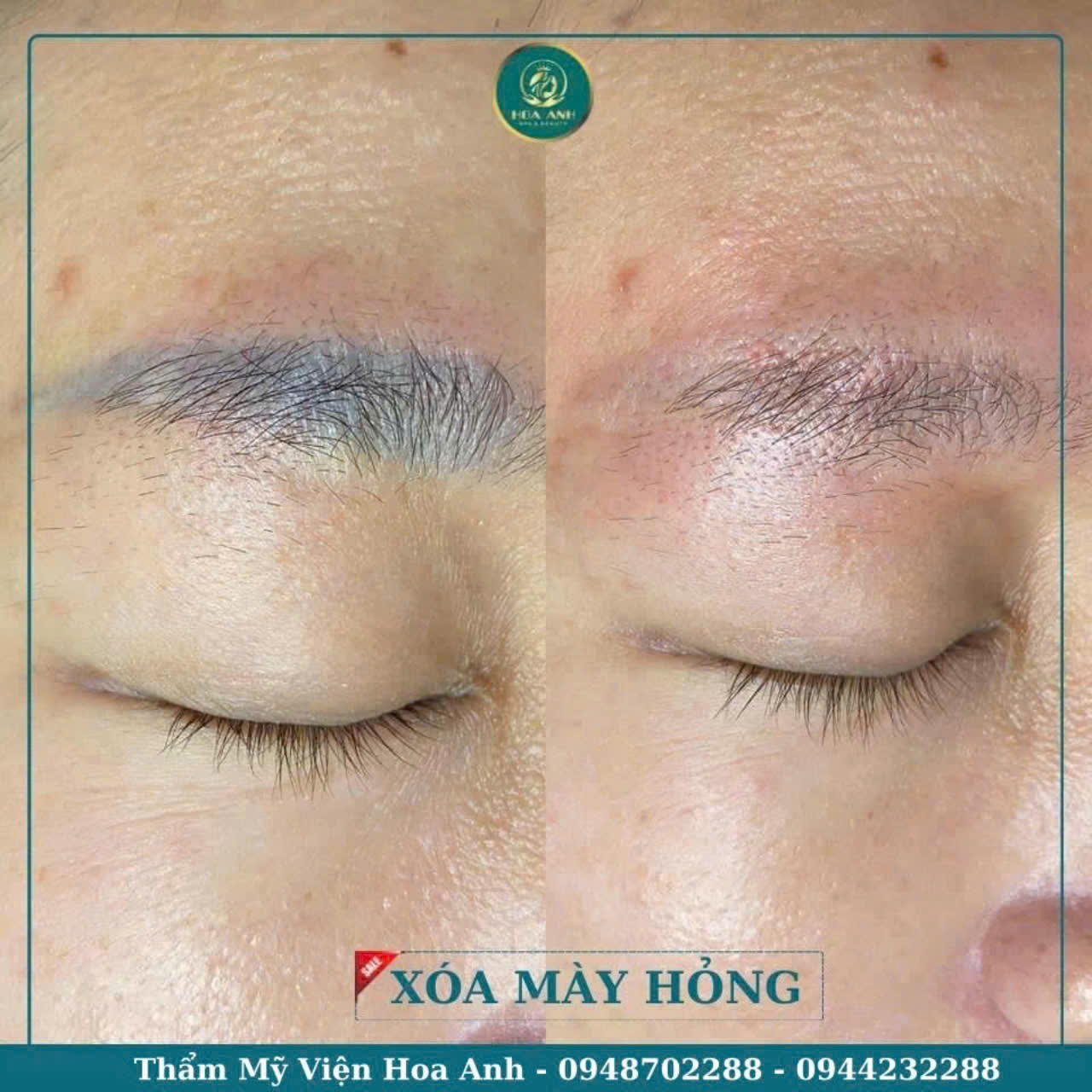 XÓA MÀY HƯ HỎNG VÀ CÁCH CHĂM SÓC SAU KHI XÓA