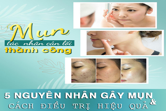 5 Nguyên nhân gây mụn và cách diều trị hiệu quả