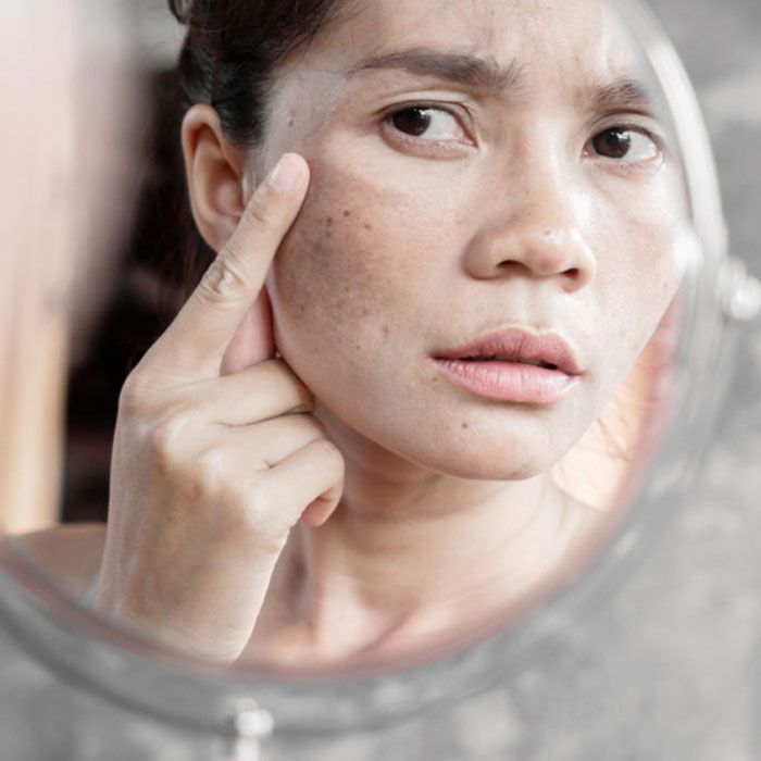 Vì sao da không đều màu? Cách khắc phục làn da không đều màu