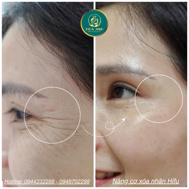 Nâng Cơ HIFU – Giải Pháp Trẻ Hóa Da Không Phẫu Thuật Tại Thẩm Mỹ Viện Hoa Anh