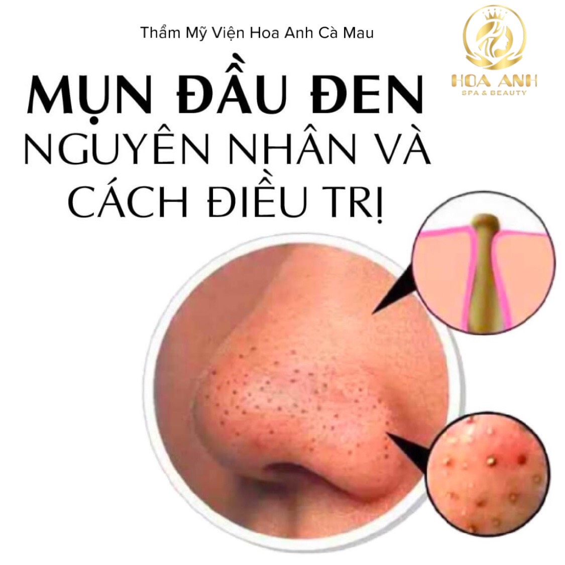 MỤN ĐẦU ĐEN - NGUYÊN NHÂN VÀ CÁCH ĐIỀU TRỊ
