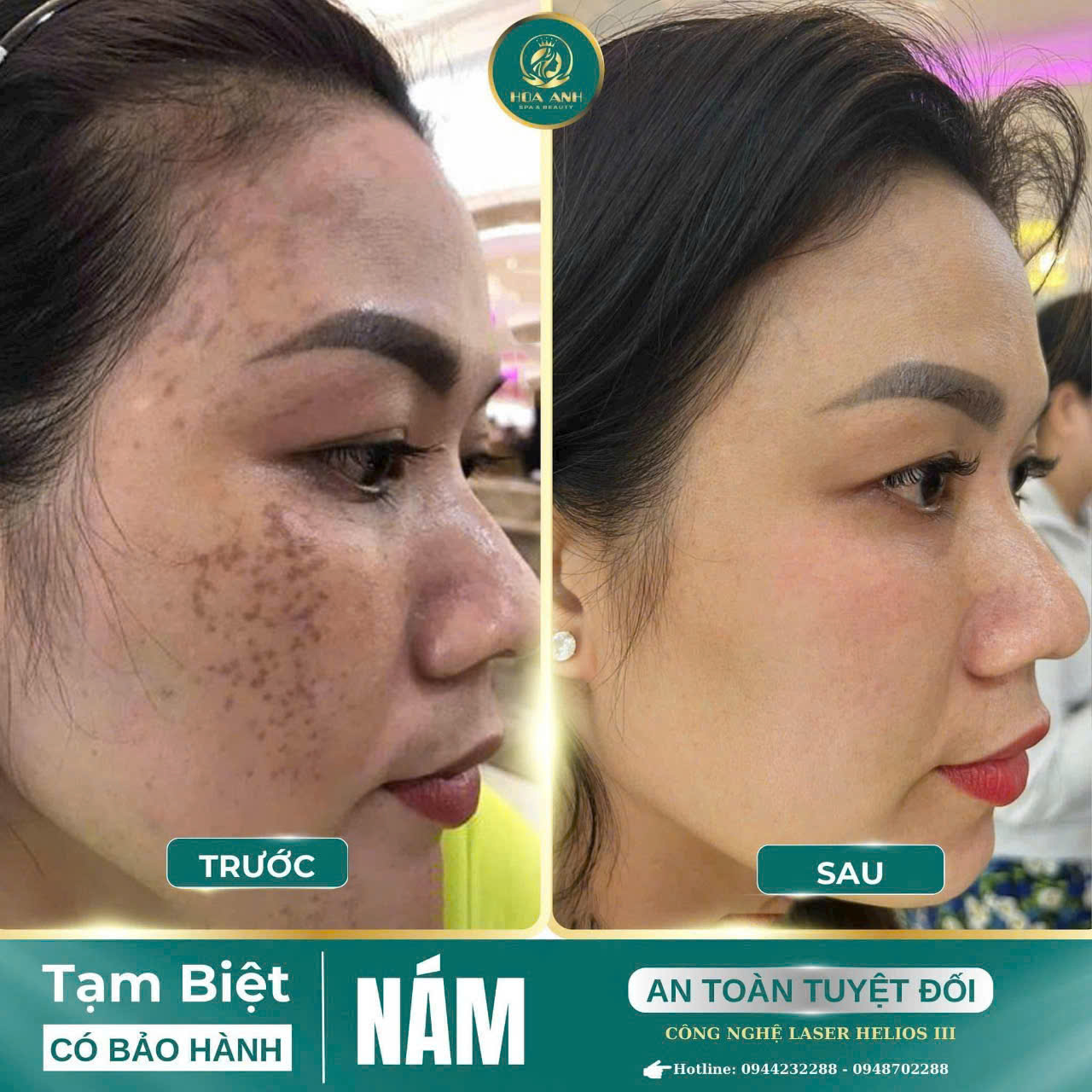 Điều Trị Nám Một Lần Có Hết Không? Giải Đáp Từ Chuyên Gia Da Liễu