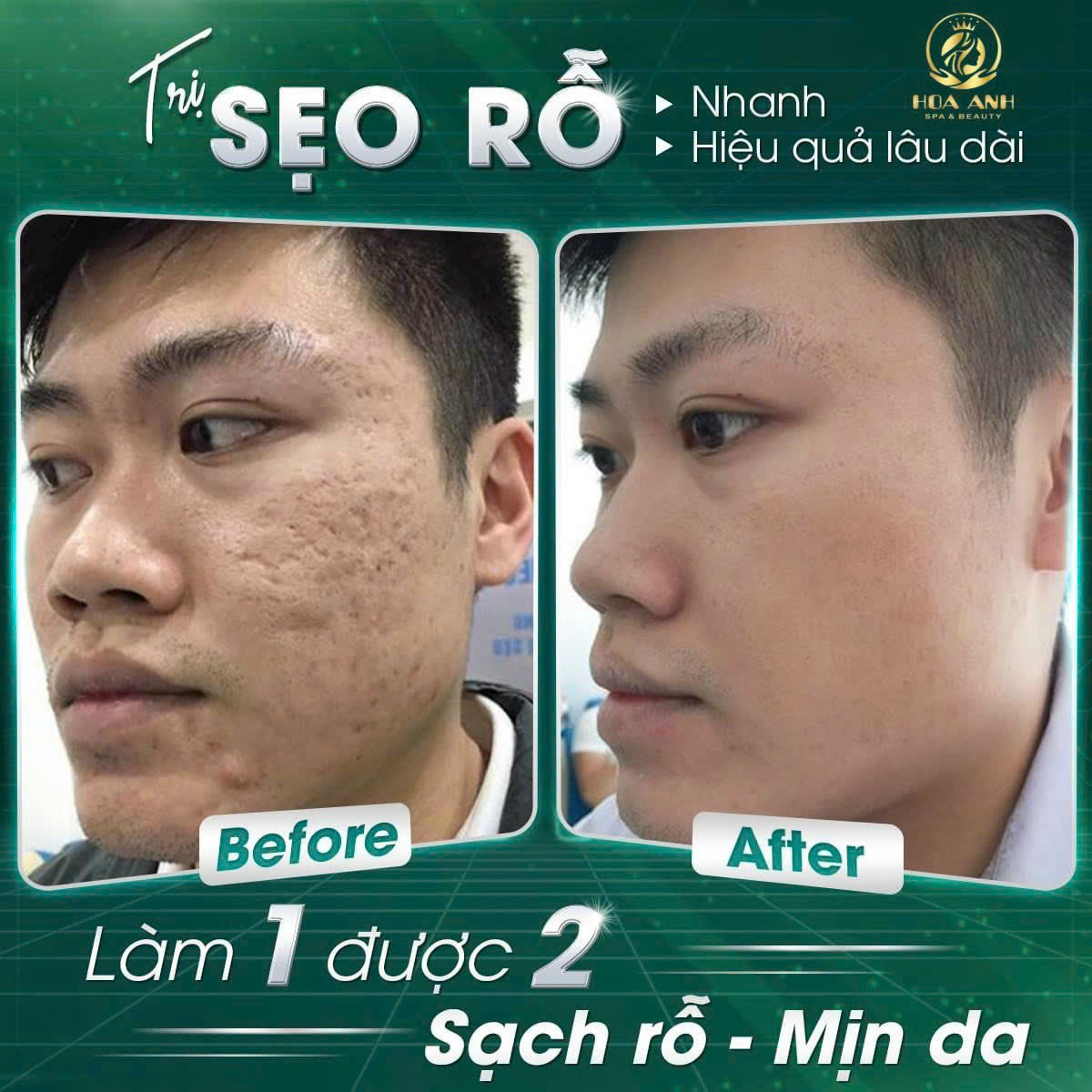 Xóa sẹo rỗ do mụn để lại ở nam có hết không? Sự thật phía sau làn da sần sùi của phái mạnh