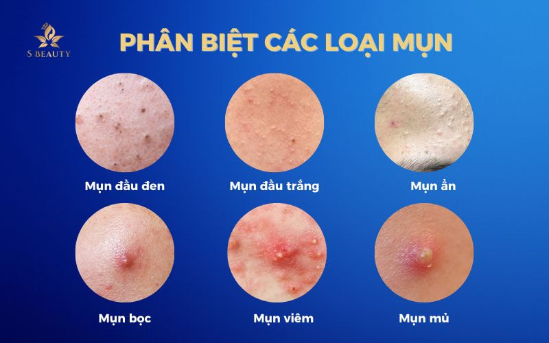 CHĂM DA SAU LẤY MỤN