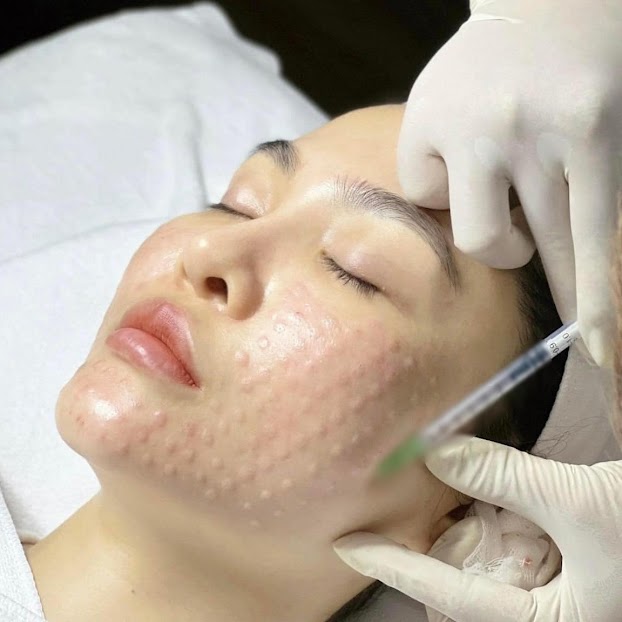 Tiêm meso có tác dụng gì? Ai nên sử dụng phương pháp tiêm meso?