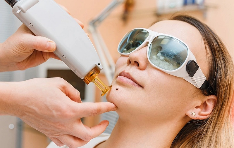 Tẩy nốt ruồi bằng laser có đau không? Có gây sẹo không?
