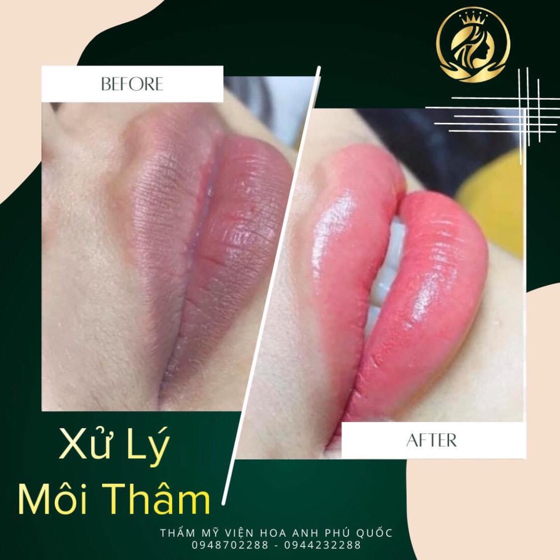 Khử thâm môi là gì? Khử thâm môi và phun môi khác nhau ở điểm nào?