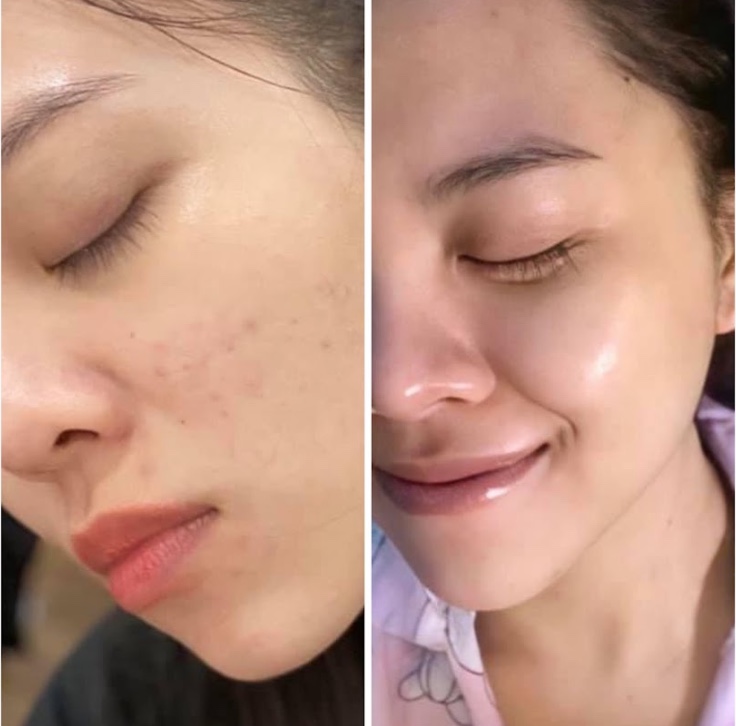 TRỊ LIỆU TRẮNG SÁNG KIM CƯƠNG CÔNG NGHỆ MESOTHERAPY