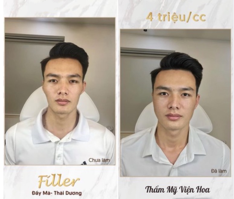 Tiêm filler thái dương hóp là gì?