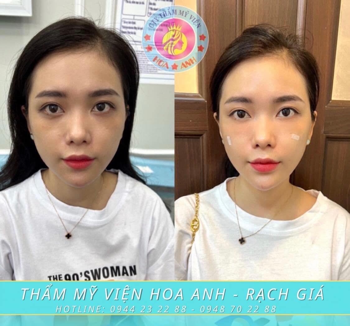 Tiêm filler làm đầy má hóp là gì?