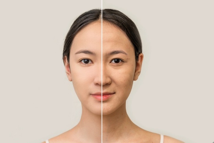 HIFU – PHƯƠNG PHÁP NÂNG CƠ