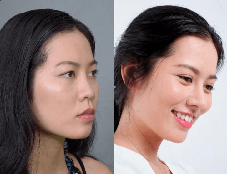 Nâng Mũi S Line Cấu Trúc