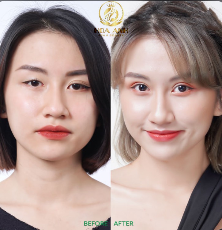 Cắt mí mắt dưới là gì? Có tác dụng gì?