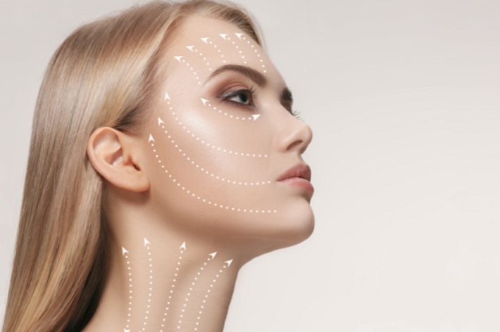 Căng chỉ collagen có an toàn không?