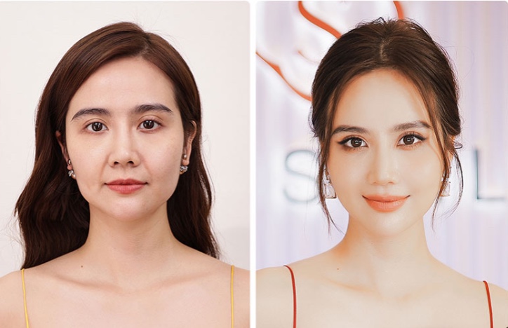 Tiêm fiiler làm đầy thái dương là gì?