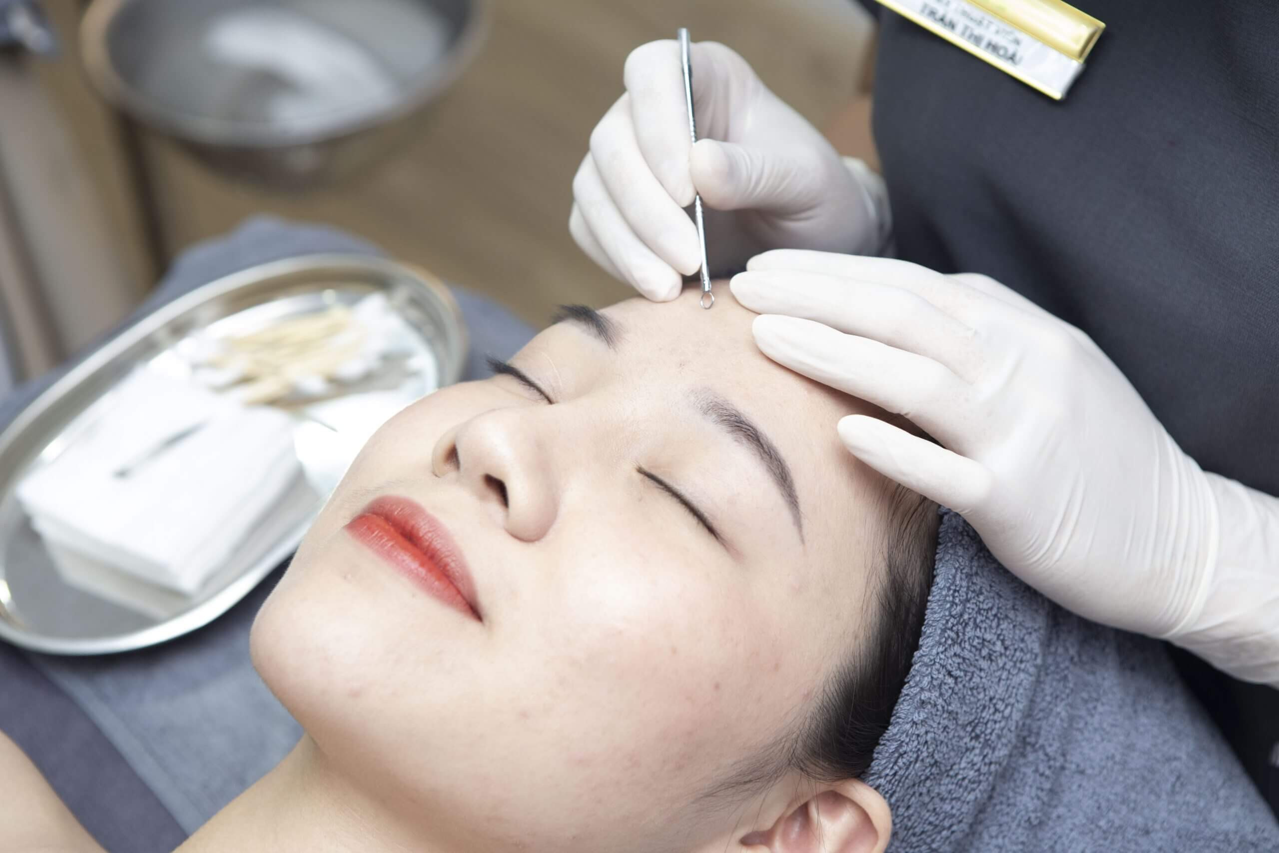 LẤY NHÂN MỤN TẠI HOA ANH CHUẨN Y KHOA