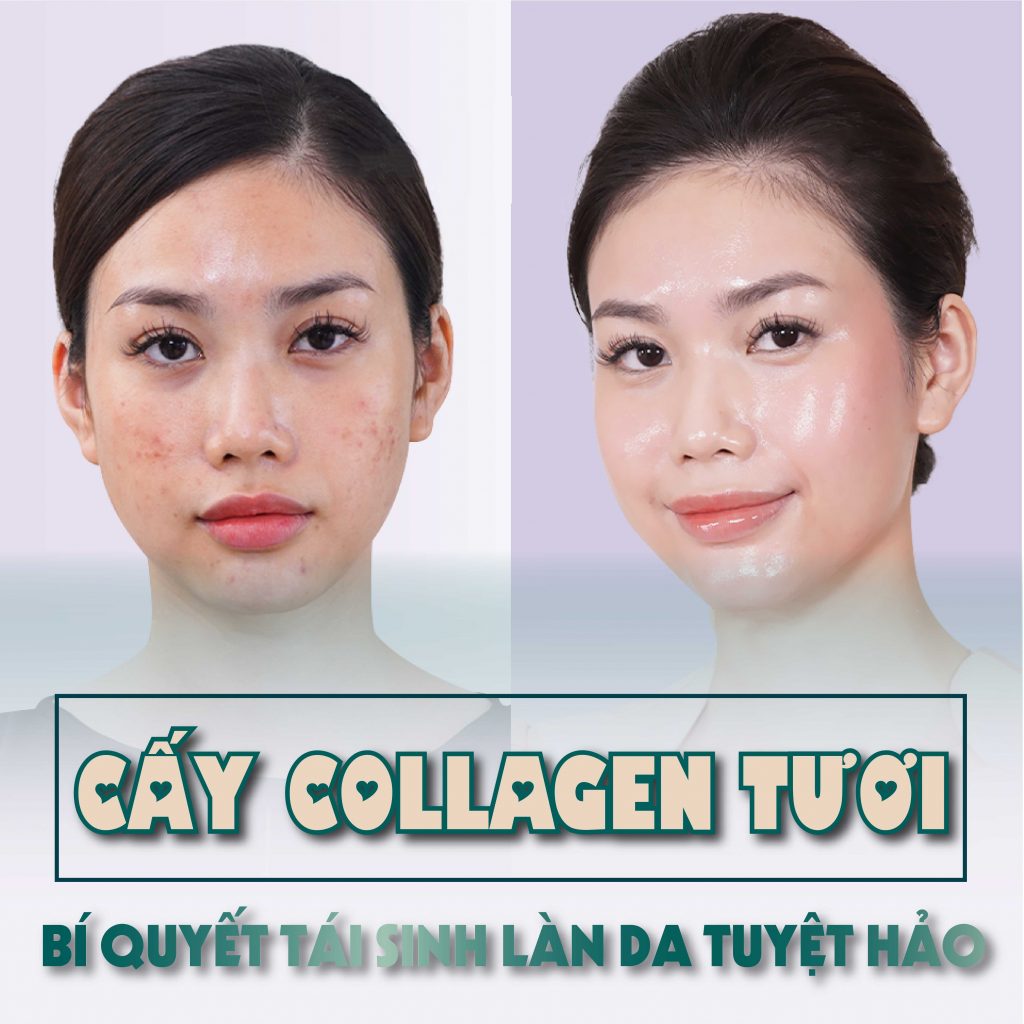 Cấy Collagen tươi giá bao nhiêu? Bảng giá cấy Collagen tươi mới nhất 2024